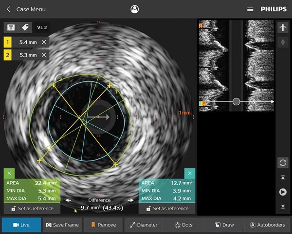 Cateteri per imaging coronarico