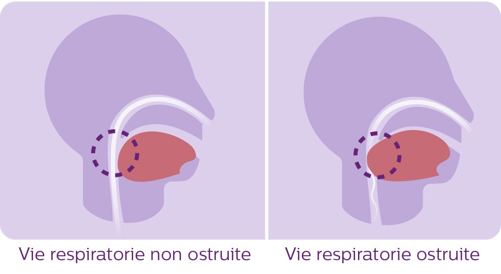 sleep apnea diagram