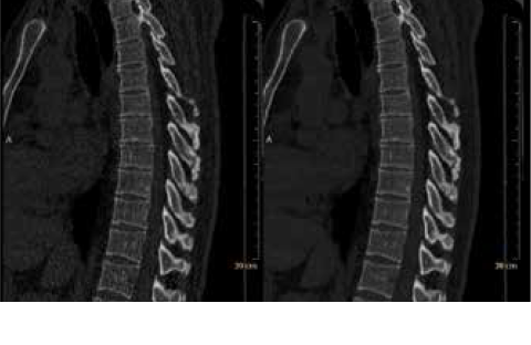 iDose attivato su imaging colonna vertebrale