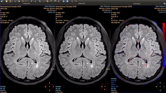 MR longitidual brain imaging