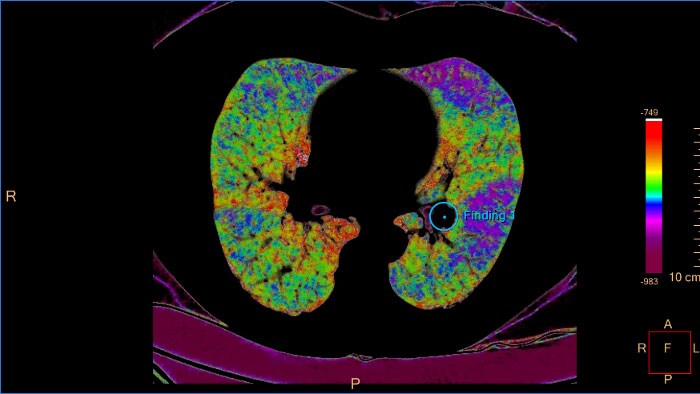 CT Pulmonary Artery Analysis CB color map