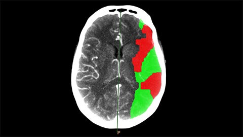 immagine clinica CT Brain Perfusion
