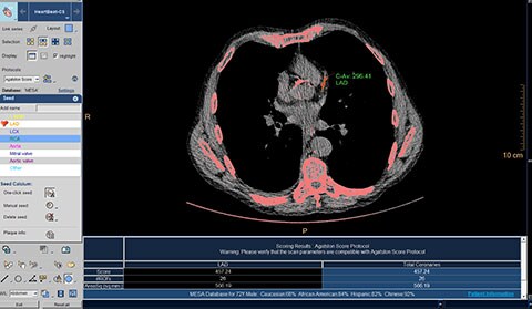 Immagine clinica ct calcium scoring