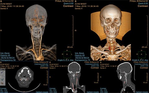 Immagine clinica multi modality advanced vessel analysis