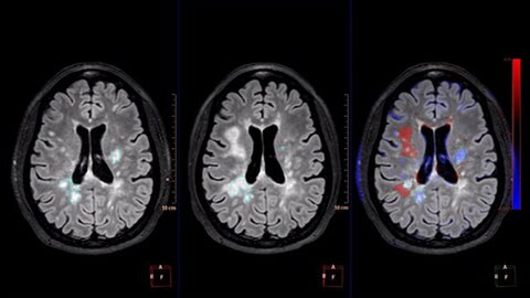 immagine clinica MR Longitudinal Brain Imaging