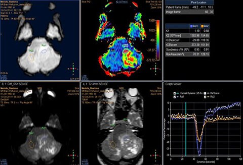 immagine clinica MR T2 Neuro Perfusion