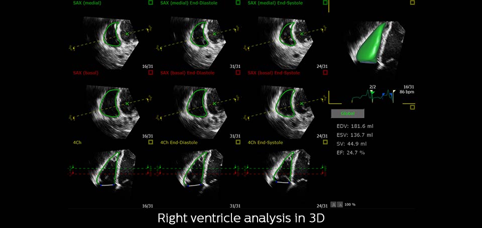 3d rv analysis
