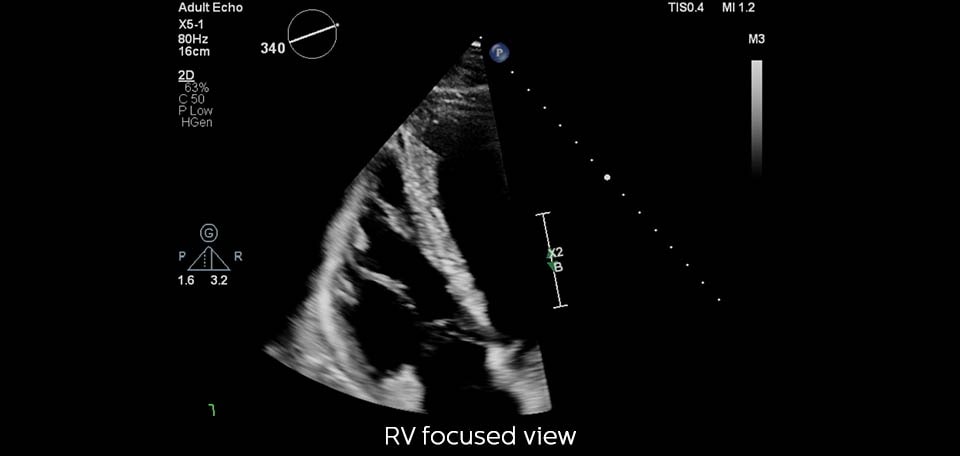 example rv focused view