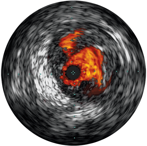 IVUS challenge standalone image