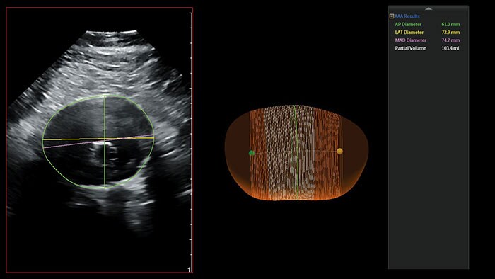 Abdominal Aortic Aneurysm Model youtube video thumbnail