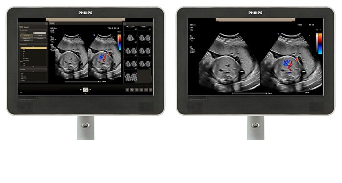 Confronto dell'area di visualizzazione con un'immagine ostetrica sullo schermo.