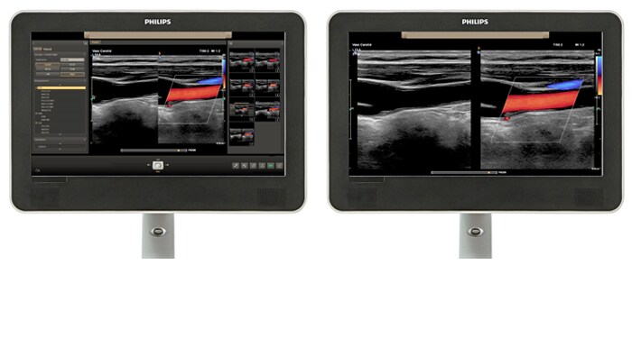 Confronto dell'area di visualizzazione con un'immagine ecografica vascolare sullo schermo