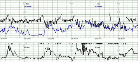 Tracciato monitoraggio fetale Philips USA polso materno velocità carta CCV1 rd3cm