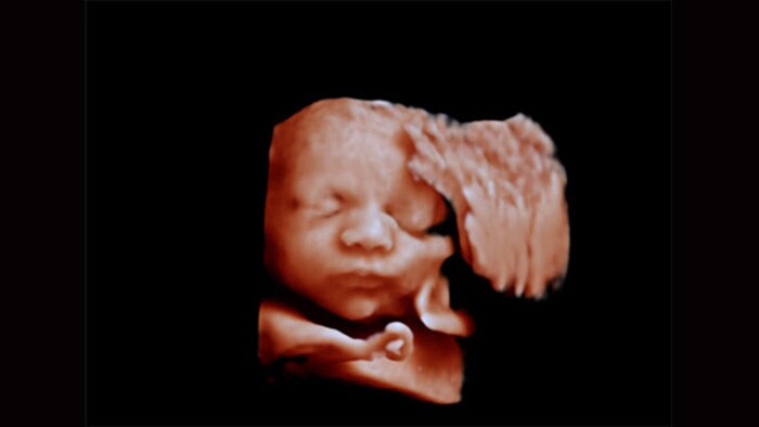 Viso del feto con sistema ecografico Philips Affiniti, aReveal applicato