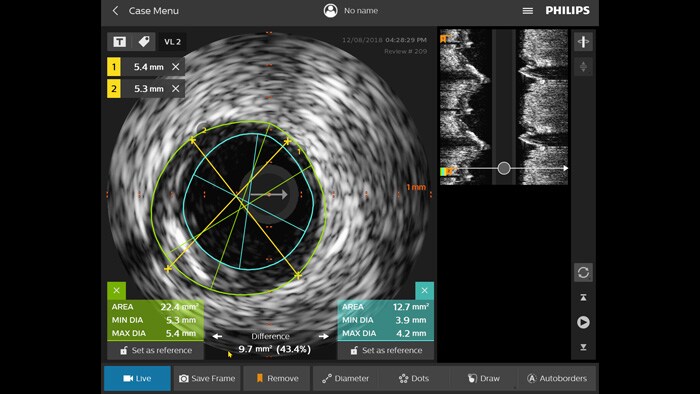 Ecografia intravascolare (IVUS)