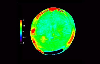 Ricorrenza del glioblastoma