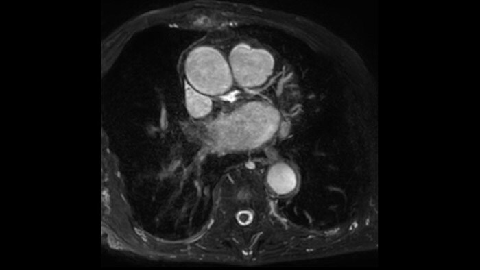 Arteria coronaria LCX