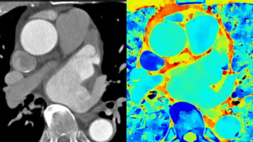 Immagine clinica TC convenzionale confrontata con immagine clinica TC basata su detettore spettrale