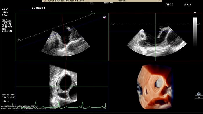 Soluzione Philips per l'auricola sinistra su EPIQ CVx