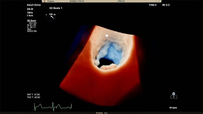 Philips Cardiac TrueVue su EPIQ CVx.