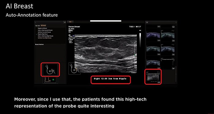 Trattamenti altamente tecnologici per il cancro al seno