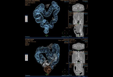 CT Virtual Colonoscopy