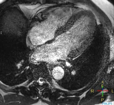 Imaging cardiaco con accelerazione convenzionale PHH