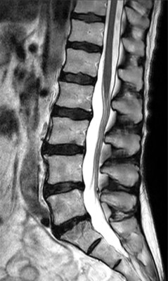 Imaging della colonna vertebrale con accelerazione convenzionale PHH