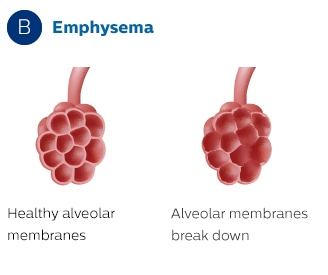Membrane alveolari