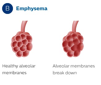 Membrane alveolari