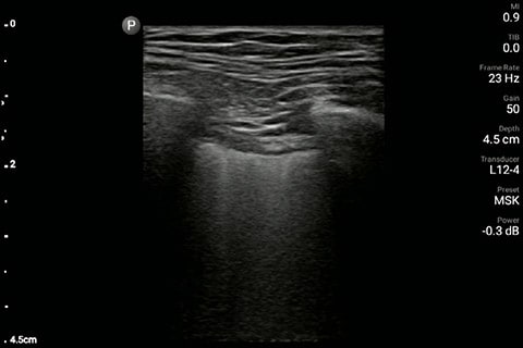 Lung image of the left chest