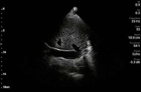 Inferior vena cave