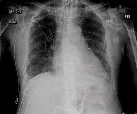 CXR