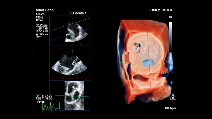 Tecnologia Philips TrueVue