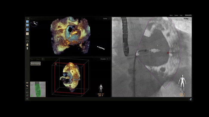 Tecnologia Philips EchoNavigator con Anatomical Intelligence