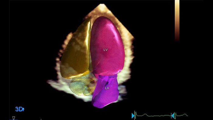 Tecnologia Philips Dynamic HeartModel