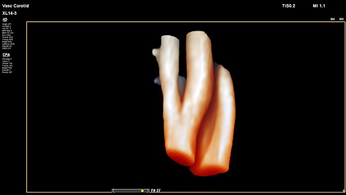 Facile valutazione dell'ubicazione spaziale e della composizione della placca e utilizzo dei dati di flusso 3D per valutare la stenosi e la tortuosità