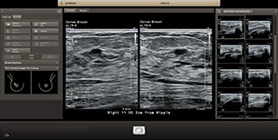 Vista a doppia immagine del piano ortogonale automatico ottenuto con la funzione Philips AI Breast