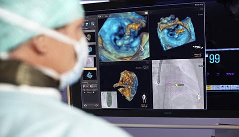 Fare la differenza nella cardiopatia strutturale con Philips Live Image Guidance