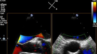 È possibile interrogare i dati Live 3D per pianificare la procedura TAVRLive 3D data to help plan TAVR 