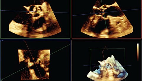 Una soluzione per il trattamento delle cardiopatie strutturali