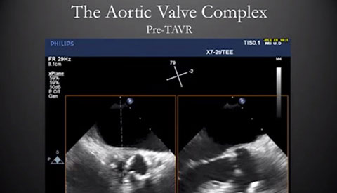 Sempre in prima linea: impianto transcatetere di una valvola aortica con HeartNavigator