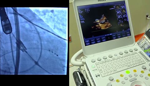 Importanza dell'ecocardiografia transesofagea 2D e 3D per l'applicazione di un dispositivo TAVR