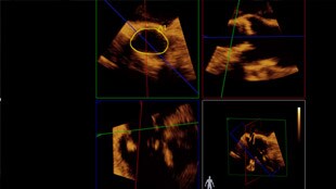 Live 3D TEE è visualizzato in tempo reale sullo schermo di EchoNavigator