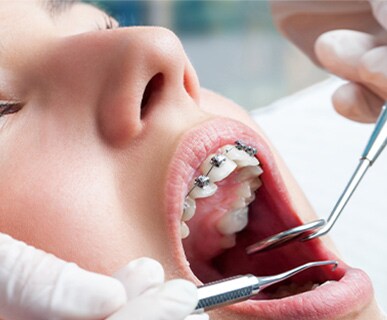 Valutazione dei vantaggi dell'utilizzo quotidiano del trattamento ortodontico Philips Sonicare
