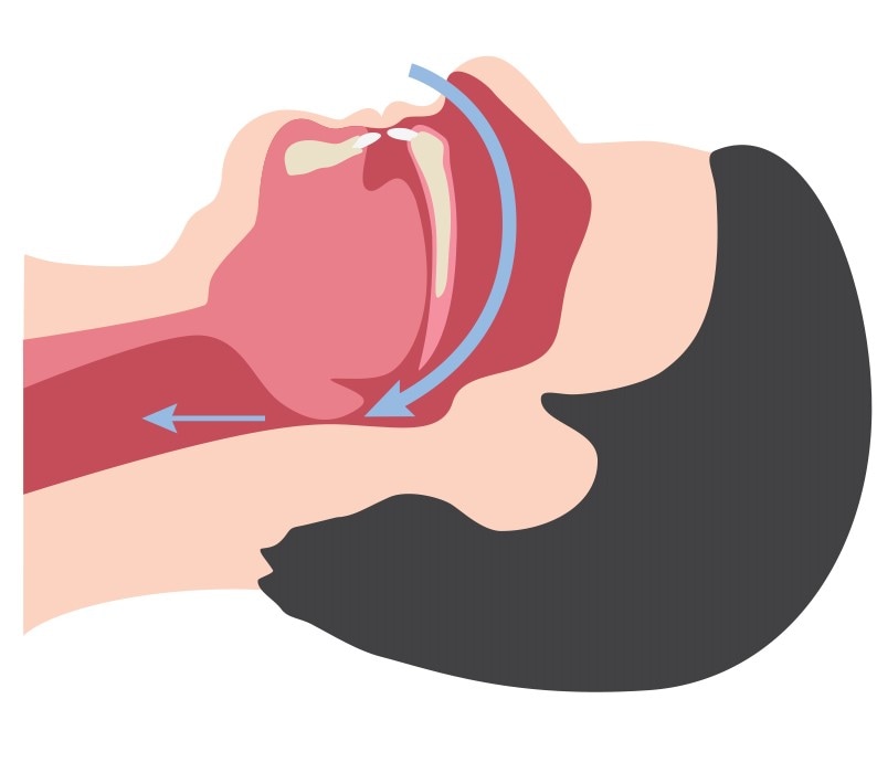 Vie respiratorie ostruite