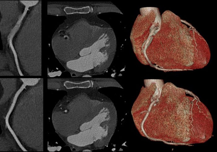 Download image (.jpg) Spectral CT 7500 Motion in Right Coronary Artery Comparison (Si apre in una nuova finestra)