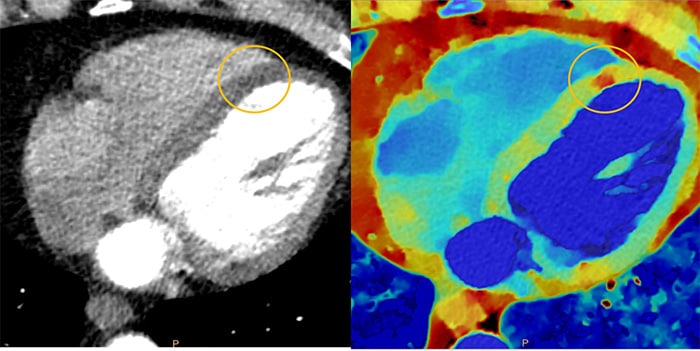 Download image (.jpg) Spectral CT 7500 Myocardial Perfusion Comparison (Si apre in una nuova finestra)