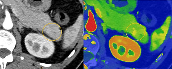 Download image (.jpg) Spectral CT 7500 Pancreatic Lesion Comparison (Si apre in una nuova finestra)
