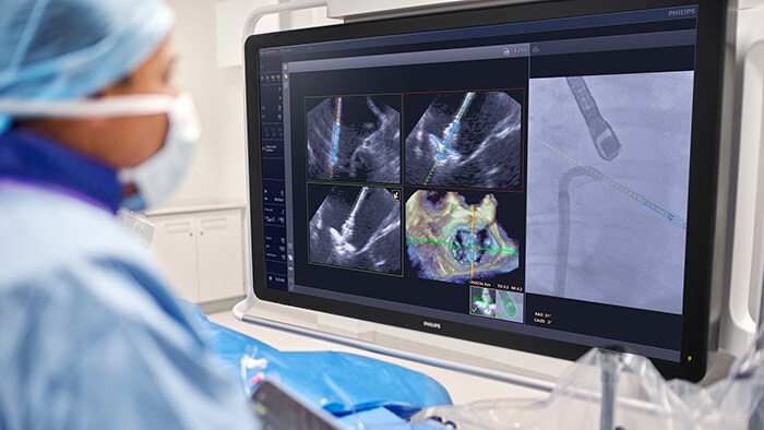 Philips brings AI into the procedure room to assist doctors during heart valve repair